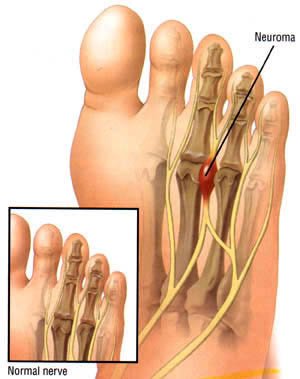 Mortonneuroma.jpg