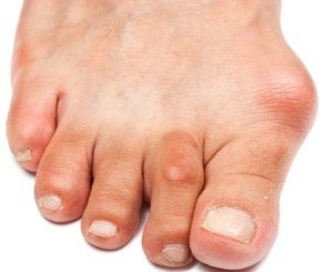 Bunions.jpg