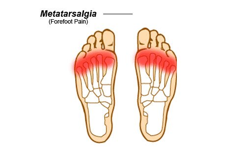 metatarsalgia.jpg