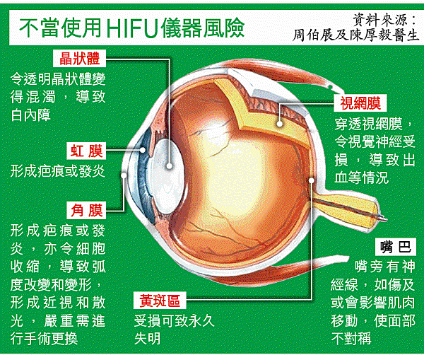 去眼袋_電眼槍_Hifu_黑眼圈_眼紋_無創膠原電眼槍.jpg