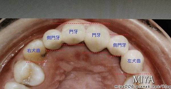 上牙牙套厚度示意.jpg