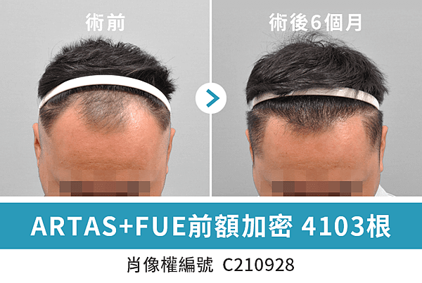 毛爵生髮診所︰ARTAS+FUE植髮案例 4103根