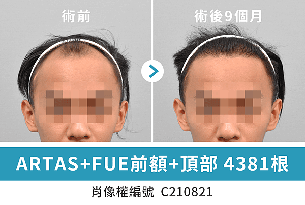 毛爵生髮診所︰ARTAS+FUE植髮案例 4381根