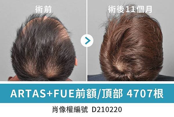 毛爵生髮診所︰ARTAS+FUE前額頂部植髮 4707根