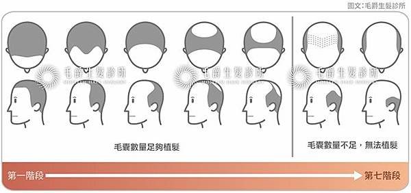 雄性禿落髮程度嚴重性