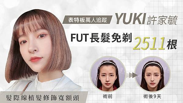 許家毓yuki女生髮際線植髮 FUE長髮免剃