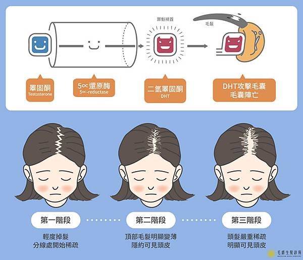 女性雄性禿徵兆與落髮階段