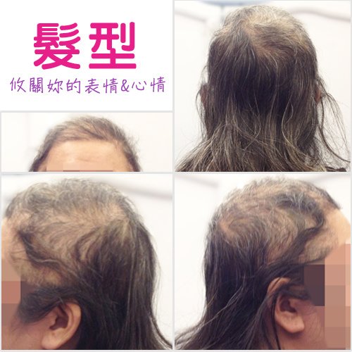 醫療假髮使用前
