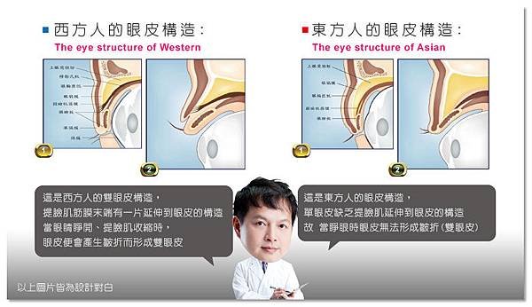 台中雙眼皮手術｜菲仕美05