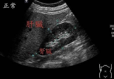 RENAL_2