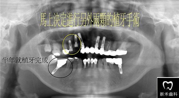 F 2013.04.29 以上牙冠