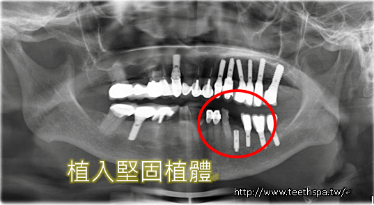 新禾牙醫爛牙快速植牙4.PNG,新禾牙醫,植牙,快速植牙,台北植牙,人工植牙,專業植牙,無痛植牙,微創植牙