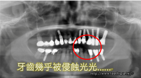 新禾牙醫爛牙快速植牙2.PNG,新禾牙醫,植牙,快速植牙,台北植牙,人工植牙,專業植牙,無痛植牙,微創植牙