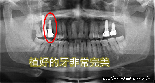 微創植牙新禾牙醫4.PNG