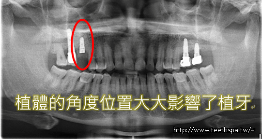 微創植牙新禾牙醫2.PNG