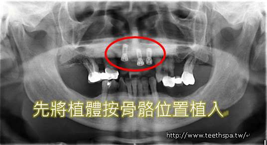 怕痛微創植牙新禾牙醫3.PNG