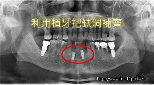 植牙快速植牙人工植牙2.PNG