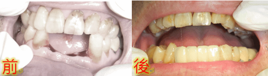 植牙快速植牙人工植牙5.PNG
