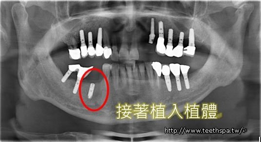 快速植牙植牙3.JPG