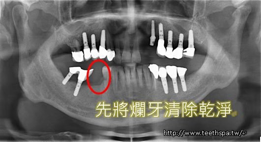 快速植牙植牙2.JPG