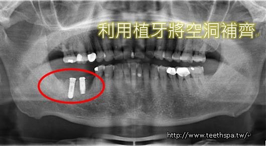 小幸運植牙3.JPG