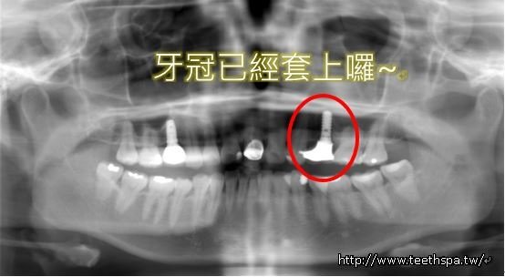 人工植牙經驗4.JPG