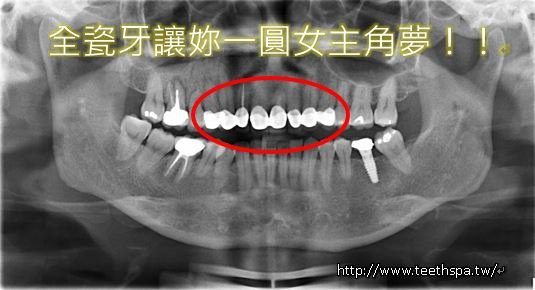 全瓷牙全瓷牙冠韓孝周2.JPG