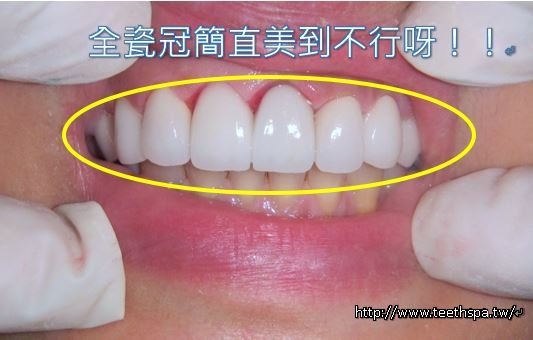 全瓷牙全瓷牙冠韓孝周3.JPG