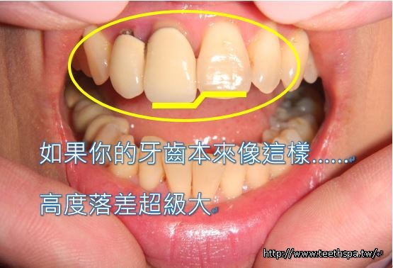 全瓷牙冠美齒1.JPG