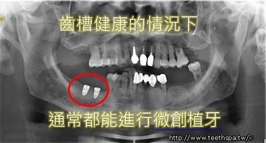 微創植牙微創植牙經驗2.JPG