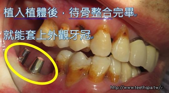 微創植牙微創植牙經驗3.JPG