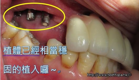 缺牙植牙4.JPG