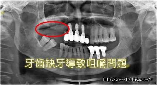 缺牙植牙1.JPG