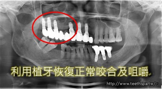 缺牙植牙5.JPG