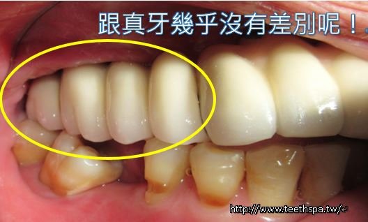 缺牙植牙6.JPG