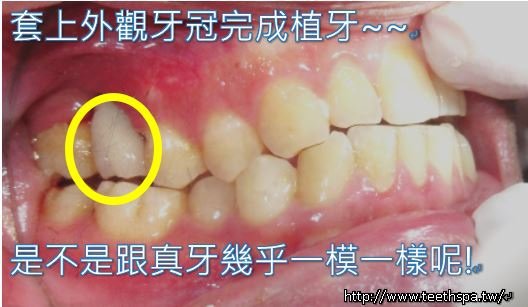 一定要植牙嗎6.JPG