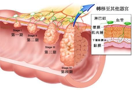 大腸癌
