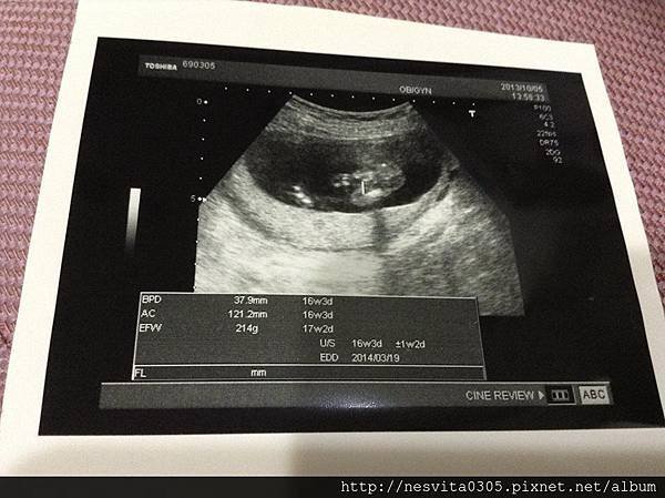 16W6D~102.10.5羊膜穿刺.jpg