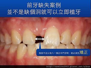 前牙植牙案例.001(1)