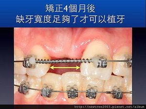前牙植牙案例.002(1)