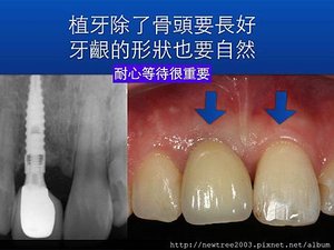 前牙植牙案例.004(1)