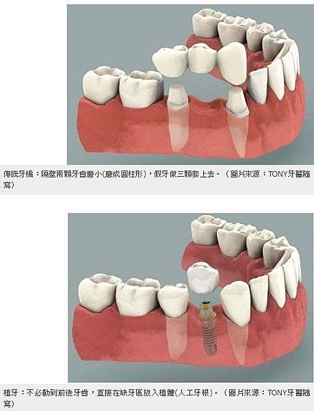 植牙費用/隱形牙套/2成6老年人全口無牙/免費假牙/老人全口