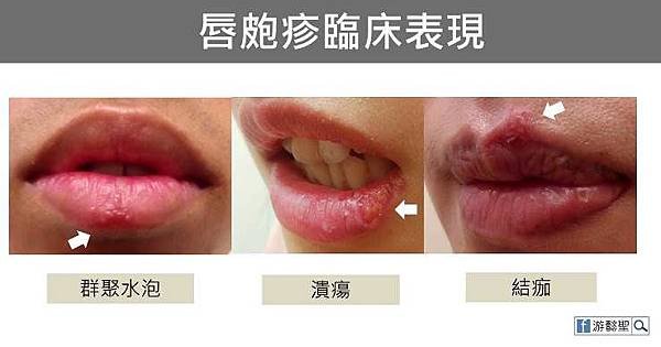 帶狀皰疹疫苗+汗皰疹/唇皰疹/蕁麻疹/有一種皮膚病，很教人討