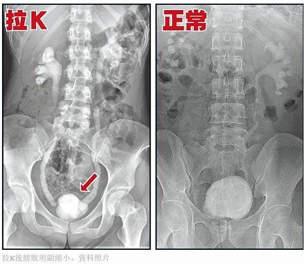 毒品拉K拉到包尿布/吸毒青少年減少 美專家：手機讓吸毒者大減