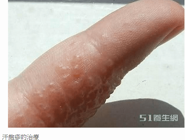 帶狀皰疹疫苗+汗皰疹/唇皰疹/蕁麻疹/有一種皮膚病，很教人討
