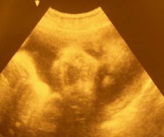 35w Baby