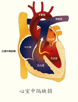 心室中膈缺損