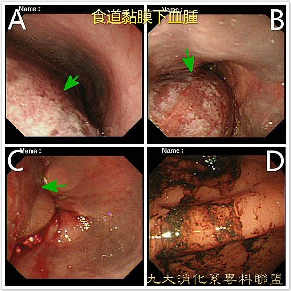 食道黏膜下血腫.jpg