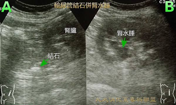 輸尿管結石併腎水腫-1.jpg