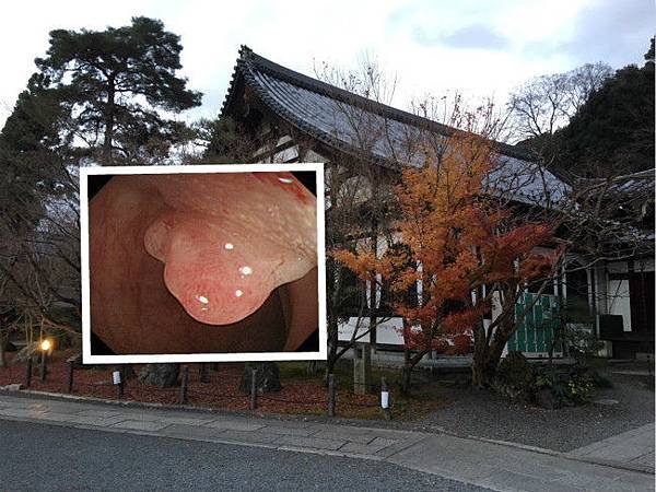 黏膜內大腸癌 ( 部落格用) (1).jpg